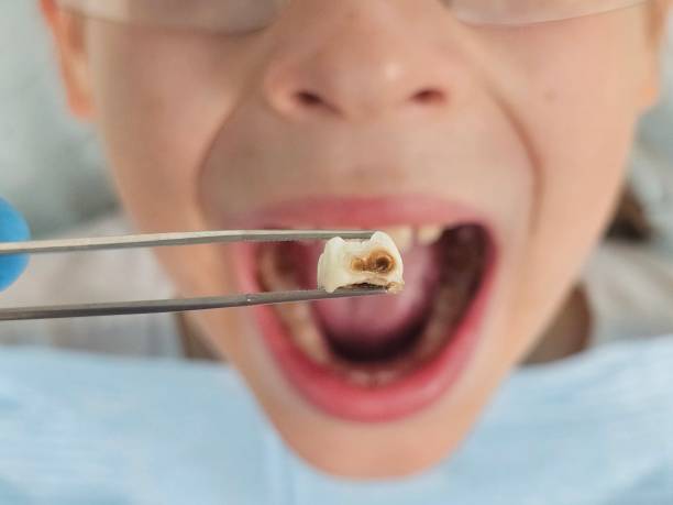 Best Emergency Broken Tooth Repair in Commerce, CA